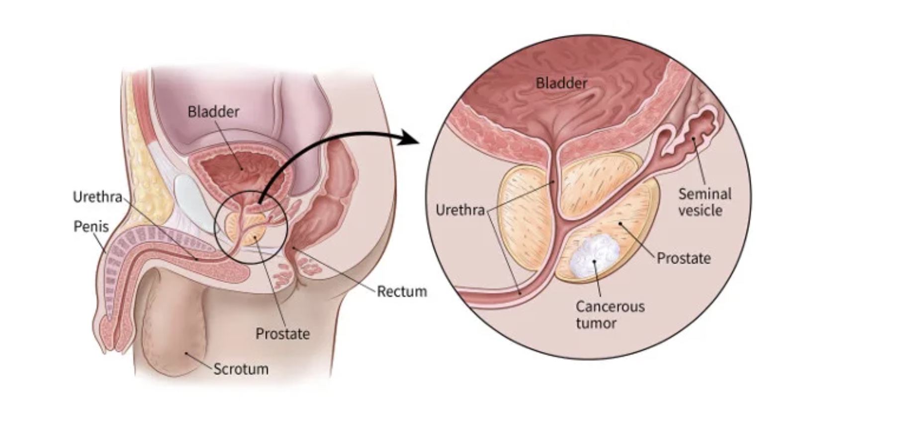 diagram showing cancers cell in Prostate